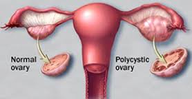 Homeopathic Treatment For Poly cystic Ovary Syndrome PCOS