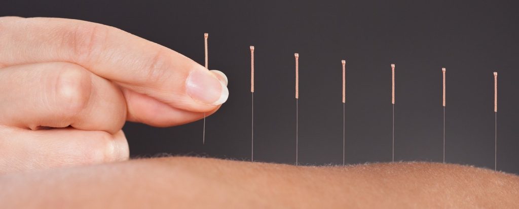Acupuncher Treatment in Mohali