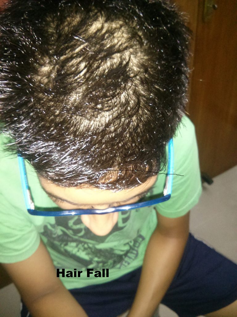 Hair/Baldness/Alopecia and Homeopathy Cure at Holac Clinic