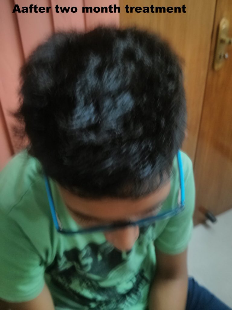 Hair/Baldness/Alopecia and Homeopathy Cure at Holac Clinic