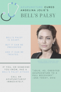 bells palsy