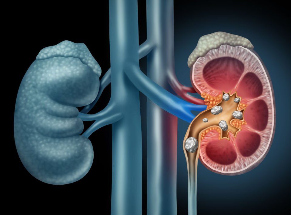 Kidney Stones